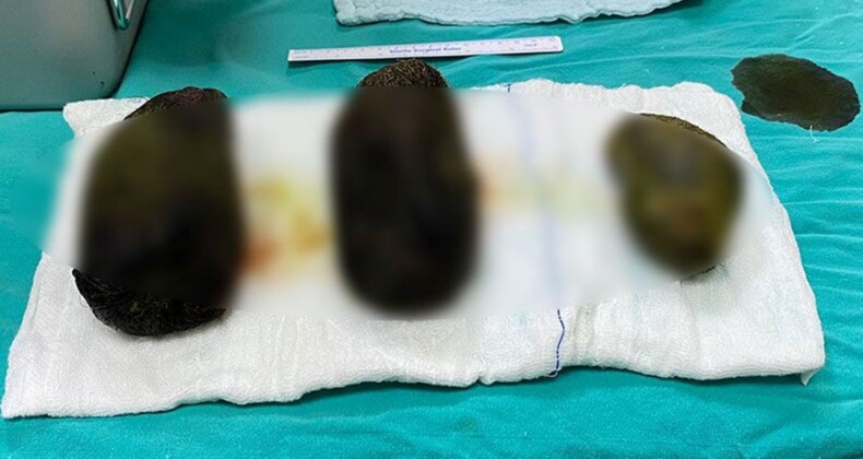 Türkiye’de yaşandı karın ağrısıyla gitti midesinden 2 kilo saç çıktı