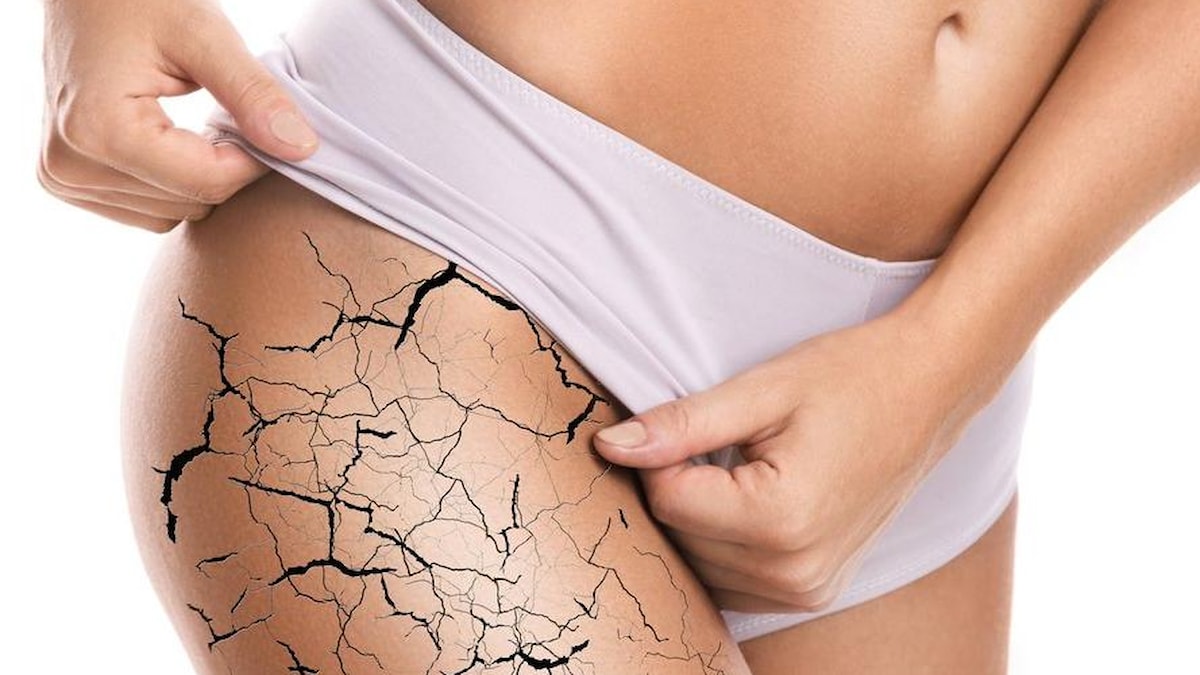 Çatlak izi nasıl geçer, çatlak izlerine ne iyi gelir?