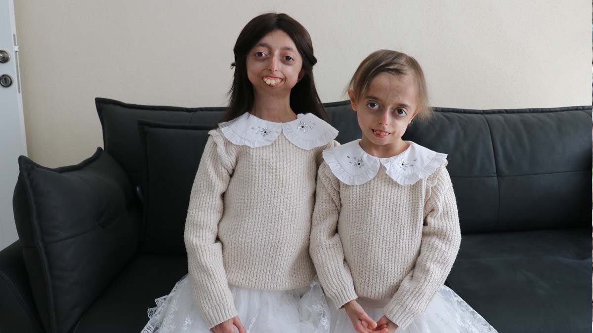 Progeria ile mücadele eden kardeşler hayata umutlu bakıyor