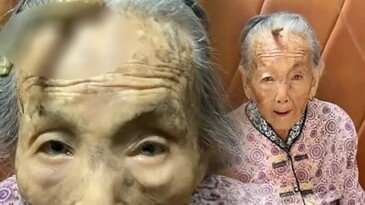 107 yaşındaki kadının boynuzu çıktı, doktorlar sebebini açıkladı