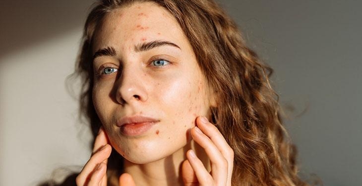 Akne, ‘nasılsa geçer’ deyip ihmal ediliyor! Geciken tedavi yüzde kalıcı izler bırakıyor