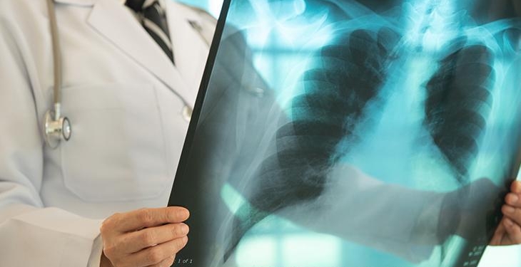 ‘Bağışıklık baskılayıcı tedaviler tüberküloz vakalarında artışa neden olabiliyor’