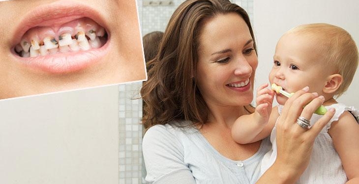 Bebeklerde sessiz tehlike: Biberon çürüğü! En sık ön dişlerde görülüyor