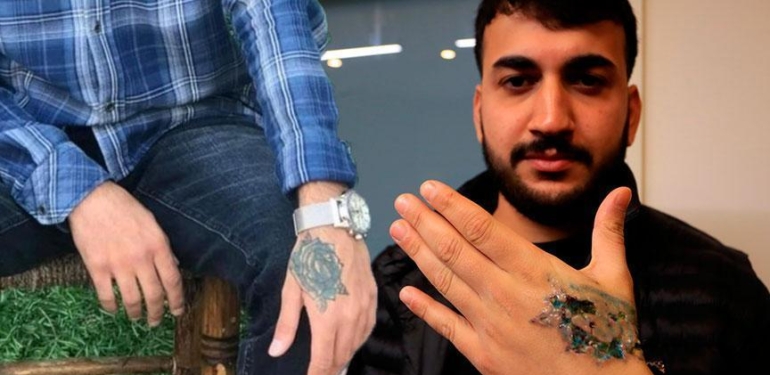 Dövme sildirmek isterken felaketi yaşadı! ‘Eczaneden ağrı kesici al’