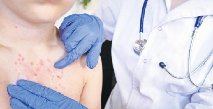 Geri mi dönüyor? Su çiçeği vakalarında artış