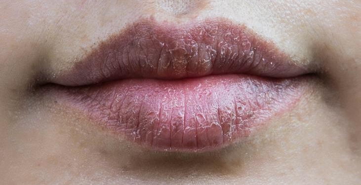 Kış aylarının en can yakan sorunu! 1 damlası yetiyor, dudakları pamuk gibi yapıyor