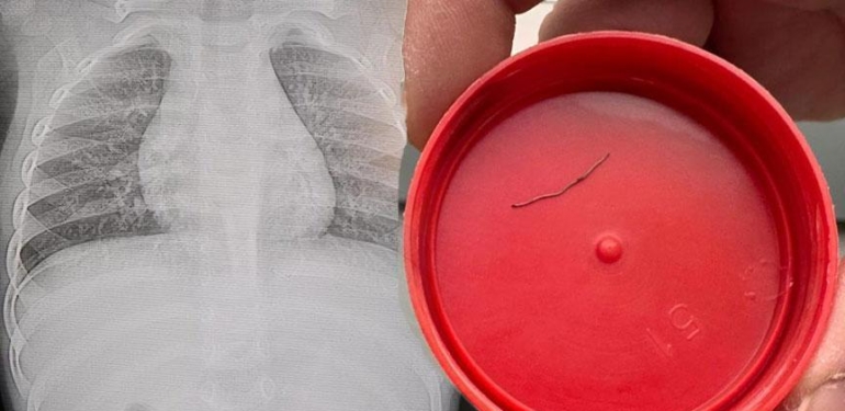 Sürekli ağlıyordu… 1 yaşındaki bebeğin sırtından çıkan şey şoke etti