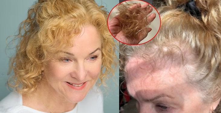 12 kilo verdi ama saçları avuç avuç döküldü! Kökleri küçülten tehlike: ‘Etkisi uzun’