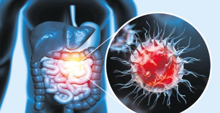 50 yaş altı kolon kanseri alarmı!