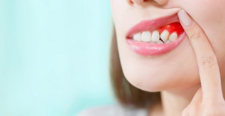 ‘Diş eti hastalıkları kalp ve damar sağlığını olumsuz etkiliyor’