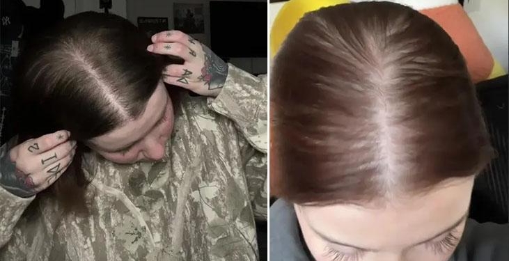 Genç yaşta saçları döküldü! Gürleştiren taktiği buldu: ‘Yağsız kullandım’