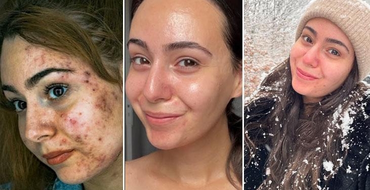 İrin akan sivilcelerinden kurtuldu, çözümü çok basit! ‘İçeriği bu asitle dolu’