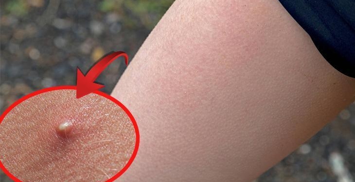 Kalçada çıkan sivilce masum mu? Uzmanlar uyarıyor: Sandığınızdan farklı bir sorun olabilir